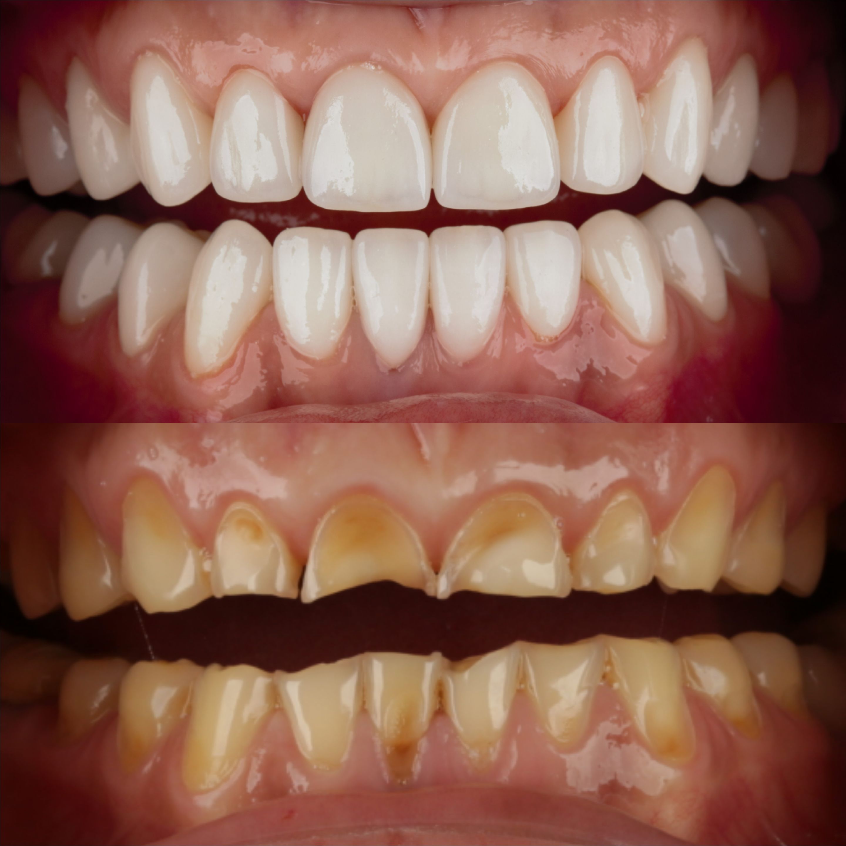 Тотальная реабилитация зубов верхней и нижней челюсти винирами - 2